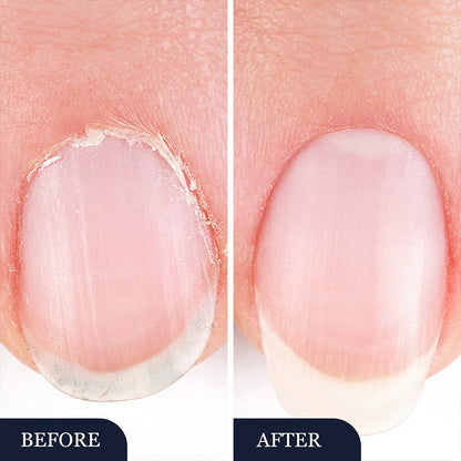Toenail Fungus Treatment Pen for Damaged Nails 💅Easily Achieve Glossy Nails